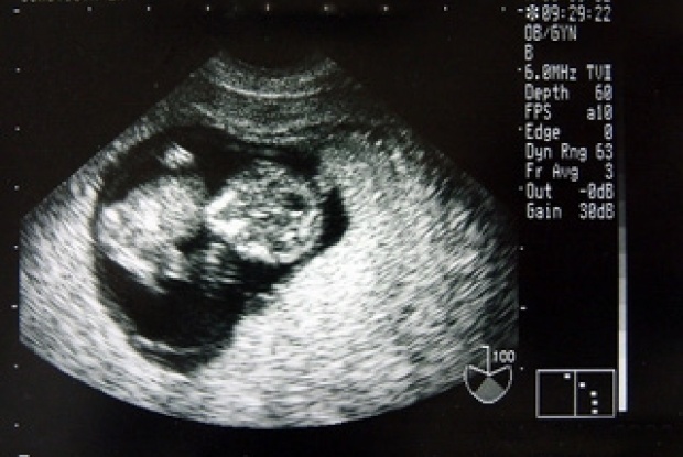 Ultraschallbild eines Ungeborenen in der 9. Woche, Foto: Von Aoineko aus der französischsprachigen Wikipedia, CC BY-SA 3.0, https://commons.wikimedia.org/w/index.php?curid=1026710