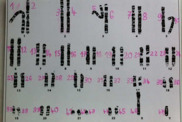 Ein Karyogramm mit 47 Chromosomen